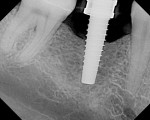 Figure 16  Radiograph of the last osteotome.