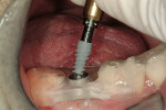 Figure 20  Introduction of the implant into the osteotomy.