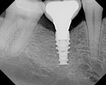 Figure 25  Radiograph of the screw-retained restoration.