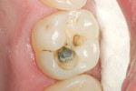 Figure 2  Amalgam was removed and the cavity was prepared.
