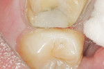 Figure 9: Early Class II cavity restored with Vertise Flow.