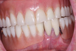 with a mandibular partial denture being poorly retained by two remaining mandibular teeth. Loss of the right third molar caused tilting of the partial denture, resulting in lift from the posterior left of the partial denture.