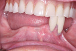 Fig 2. Severe bilateral ridge resorption was evident with the partial denture removed. The patient was applying denture adhesive two to three times per day to be able to function without discomfort.