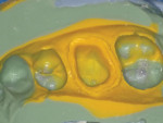Fig 2. An impression was made using a vinylpolysiloxane impression material (Aquasil®, Dentsply Sirona, dentsply.com).