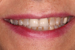 Fig 1. This patient had been treated with porcelain-fused-to-metal (PFM) crowns on teeth Nos. 8 and 9 more than 30 years ago. Now, just before her 60th birthday, she had significant wear and wanted a new smile that would last for the rest of her life.