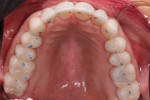 Fig 10. New occlusal foundation with stable centric stops on all teeth, coinciding with CR.