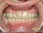 Figure 7  Note the very dark right central incisor, and severe wear due to nocturnal bruxism.