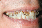 Figure 10  Preoperative condition shows severe destruction of the maxillary teeth.