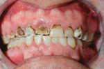 Figure 11  Preoperative condition shows severe destruction of the maxillary teeth.