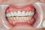 Figure 13  The provisionals immediately after treatment; the result of the soft tissue recontouring is evident.