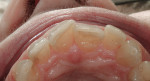 Figure 3  Preoperative incisal view, showing malaligned front teeth.