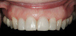 Figure 9  Immediate postoperative facial view.