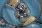 Figure 4A Methylene blue dye brushed on enamel cracks before removal of amalgams.