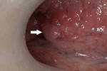 Figure 1  An intraoral examination using incandescent light shows a pink papule at the posterior lateral border of the tongue, identified by the white arrow.