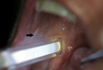 Figure 3  An intraoral examination using chemiluminescent light shows an “acetowhite” patch on the right buccal mucosa, identified by the black arrow. (Photo courtesy of Michael A. Kahn, DDS; Boston, MA.)