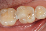 Figure 1  The defective restoration on the first lower molar was removed and prepared for an indirect onlay restoration.