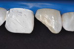 Tooth preparation to receive a Class
IV resin composite restoration. Tooth No. 8 isolated with Teflon tape in order to protect it
against accidental etching.