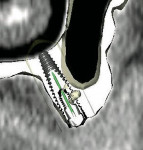 Figure 11f  Cross-sectional images, virtual treatment plan for implant placement in the anterior nasal spine region <strong>(E)</strong>, and left premolar region <strong>(F)</strong>.