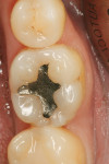 Figure 1  The patient desired to remove an unsightly amalgam restoration on tooth No. 19.