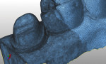 Fig 4. Closer detail of the 3D mesh near the prep, showing the denser data which provides more features.