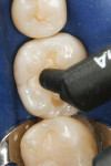 Figure 9  A dentin body shade of composite was applied and filled to the dentin-enamel junction in 2-mm increments without connecting the opposing lateral walls to manage polymerization stress on the bond.