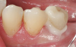 Figure 7  Buccal view of the fired IPS e.max CAD lithium-disilicate crown inserted using the transparent shade of SpeedCEM cement.