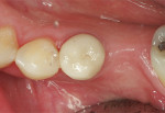 Figure 8  Occlusal view of the IPS e.max lithium-disilicate crown restoration immediately after cementation.