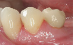 Figure 9  Buccal view of the definitively cemented IPS e.max lithium-disilicate crown restoration.