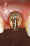 Figure 4  A trial fit was made with the selected Flexi-Flange post to ensure proper fit prior to cementation.
