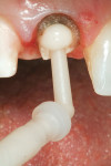 Figure 5  The self-cure resin cement was dispensed into the post preparation through the automix tip and tip extension.