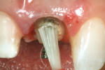 Figure 8  An adhesive bonding resin was applied to the etched tooth surface and light-cured.