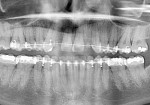 Figure 2  Once orthodontics was completed the implants were placed.
