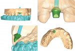 Figure 4  CAD/CAM technology can be utilized to provide the optimal function and esthetics for individualized care.