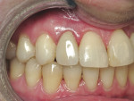 Figure 5  The case was completed by the prosthodontist with all-ceramic crowns.