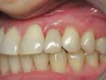 Figure 6  The case was completed by the prosthodontist with all-ceramic crowns.