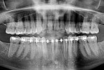 Figure 7  The roots of the central incisors and canines were found to compromise the required space for proper implant placement.