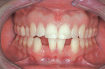Figure 8  The patient elected to accept additional orthodontic treatment to realign the centrals and canines to develop an appropriate implant site.