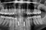 Figure 9  Dental implants were placed.