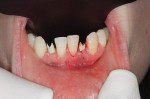 Figure 10  Dental implants were placed.