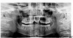 Figure 13  Based on the root alignment and existing bone support, it was concluded that Astra Tech OsseoSpeed 3.0 S implants would be optimal for the horizontal space of the implant site and to provide restorative flexibility.