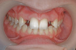 Figure 15  The provisional restoring tooth No.10 was undercontoured to promote further gingival adaption using a modified technique developed by the author.