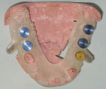 Figure 12d  Next, the virtual treatment plan, occlusal view, NobelGuide <strong>(C)</strong>. Model with stone removed posteriorly,implant analogs secured bilaterally in NobelGuide <strong>(D)</strong>. Provisional restoration with internal titanium