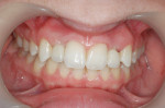 Figure 16  The provisional restoring tooth No.10 was undercontoured to promote further gingival adaption using a modified technique developed by the author.