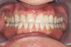 Fig 11. Fractured all-zirconia abutment.