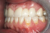 Fig 12. Path of draw necessitates adjustment to adjacent tooth or cement-retained restoration.