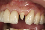 Figure 2  Final tooth preparation.