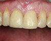 Fig 19. In 2016, downward growth of tooth No. 8 could be observed with uneven gingival margins of Nos. 8 and 9.