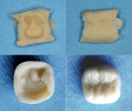 Figure 9  Block form provisional after removal from the mouth and hand carved.