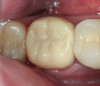 Fig 4. Clinical view of the area 3 months post-therapy. Shallow probings of 3 mm were present around the dental implants with absence of bleeding. However, the mucogingival deformities remained on the premolar implants and would require treatment.