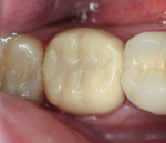Figure 10  Block form acrylic provisional cemented in the mouth.